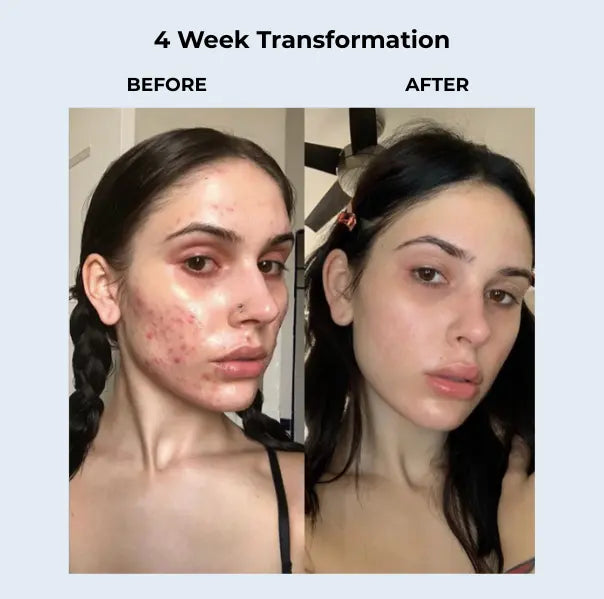 DermaClear™ Acne Treatment